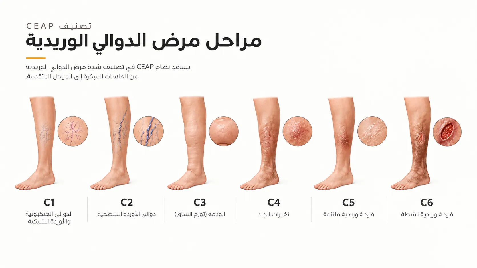 رسم توضيحي لتصنيف CEAP لمراحل القصور الوريدي