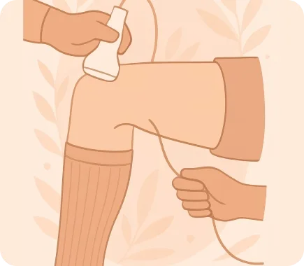 رسم توضيحي لآلية عمل تقنية الكلاري فين ClariVein